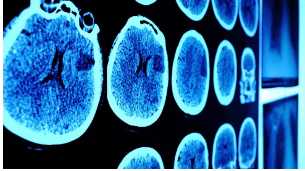 AlzheimersRisk